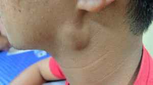 Red Flag Limfadenopati Servikal