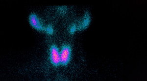 Peran Thyroid Scintigraphy dalam Mendiagnosis Kelainan Tiroid