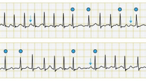 Parameter Gelombang P sebagai Prediktor Risiko Stroke pada Atrial Fibrilasi