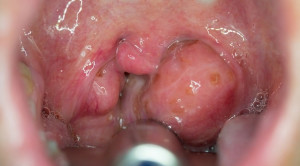 Indikasi Tonsilektomi pada Anak