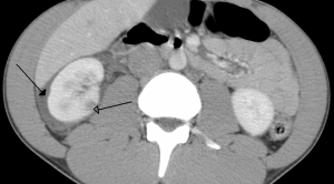 Manajemen Trauma Tumpul Limpa: Operatif Vs Nonoperatif