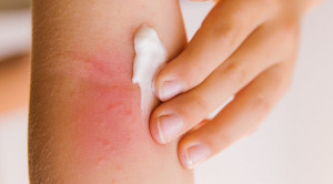 Efikasi Emolien Rutin untuk Mencegah Dermatitis Atopik Anak