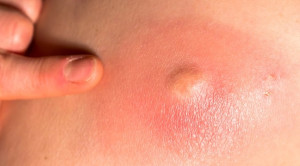 Penggunaan Antibiotik untuk Abses Kulit Tanpa Komplikasi