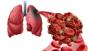 Penggunaan Sistem Skoring pada Emboli Paru