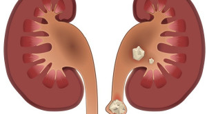 Alpha Blocker untuk Manajemen Batu Saluran Kemih