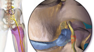 Efektif Tidaknya Pregabalin untuk Terapi Skiatika