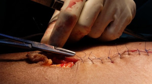 Teknik Penutupan Laparotomi untuk Mengurangi Risiko Hernia Insisional