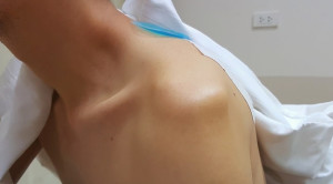 Tata Laksana Bedah vs Konservatif untuk Dislokasi Sendi Akromioklavikular