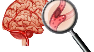 Perbandingan Kombinasi Ticagrelor dan Aspirin atau Aspirin Tunggal untuk Stroke Iskemik Akut – Telaah Jurnal Alomedika