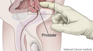 Pilihan Metode Skrining Kanker Prostat