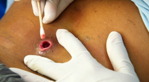 Pemberian Antibiotik Sistemik Untuk Abses Kulit dan Jaringan Lunak