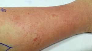 Pemilihan Antibiotik Oral vs Parenteral untuk Terapi Selulitis