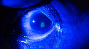 Efektivitas dan Keamanan Penggunaan Anestetik Topikal pada Abrasi Kornea