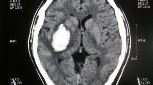 Target Tekanan Darah pada Pasien dengan Pendarahan Intraserebral Akut