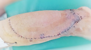 Evaluasi Vitalitas Flap