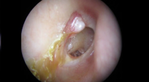 Antibiotik Topikal VS Sistemik untuk Otitis Media Supuratif Kronis