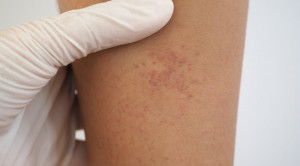 Pedoman Tata Laksana Immune Thrombocytopenic Purpura oleh American Society of Hematology 2019