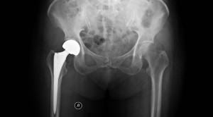 Efektivitas Hemiarthroplasti dengan vs tanpa Semen dalam Penatalaksanaan Fraktur Intrakapsular Panggul – Telaah Jurnal Alomedika