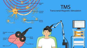 Penggunaan Non Invasive Brain Stimulation (NIBS) pada Gangguan Cemas Menyeluruh