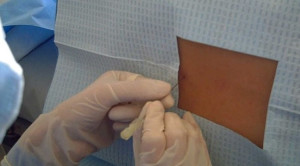 Prosedural Pungsi Lumbal pada Pasien yang Mendapat Antiplatelet