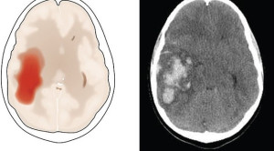Asam Traneksamat Belum Terbukti Efektif untuk Perdarahan Intraserebral Akut