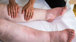 Red Flag Bengkak pada Tungkai Bawah