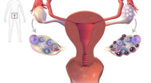 Rasionalisasi Pemberian Metformin pada Sindrom Ovarium Polikistik