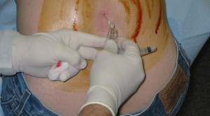 Pilihan Jenis Jarum untuk Pungsi Lumbal