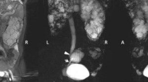 Perbandingan Efikasi Terapi Farmakologi Pasien Dewasa Dengan Penyakit Ginjal Polikistik Autosomal Dominan: Tinjauan Sistematik dan Meta-analisis Jaringan Dari Percobaan Acak Terkontrol - Telaah Jurnal Alomedika