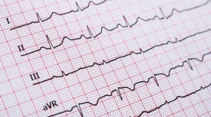 Memahami Gelombang P dalam EKG