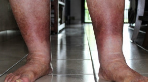 Red Legs: Membedakan Selulitis dari Penyebab Lain