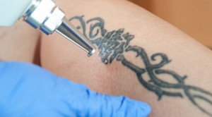 Manajemen Optimal untuk Mencegah Komplikasi Tattoo Removal Menggunakan Terapi Laser