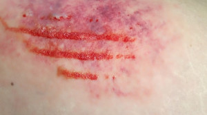 Perbandingan Efikasi Obat Antiinflamasi Nonsteroid dan Analgesik Lain pada Cedera Jaringan Lunak