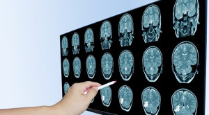 Manifestasi Klinis Peningkatan Tekanan Intrakranial