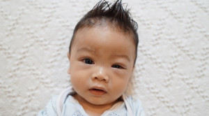 Profilaksis Oftalmia Neonatorum: Apakah Masih Relevan?