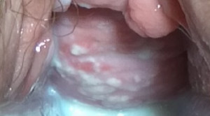 Perbandingan Efikasi Antifungal Peroral dan Intravaginal pada Kandidiasis Vulvovaginal Nonkomplikata