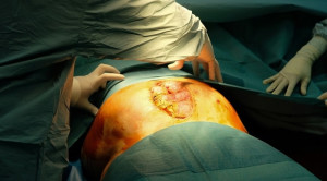 Pedoman Manajemen Sepsis Intraabdominal dalam Perspektif Indonesia