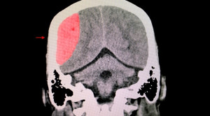 Kapan Dilakukan Penatalaksanaan Non Operatif pada Epidural Hematoma?
