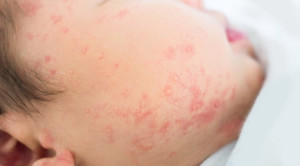 Peran Formula Hidrolisat Parsial terhadap Pencegahan Alergi pada Anak