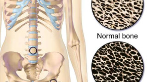 Pencegahan dan Terapi Osteoporosis akibat Glukokortikoid