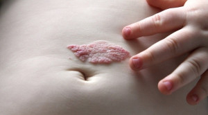 Manajemen Hemangioma Risiko Tinggi pada Anak