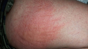 Manajemen Psoriasis pada Pasien Obesitas