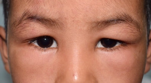 Penggunaan Kortikosteroid untuk Sindrom Nefrotik pada Anak