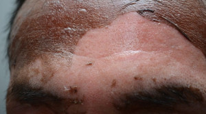 Basis Bukti Ilmiah Penggunaan Antimikrobial Topikal pada Luka Bakar Area Wajah