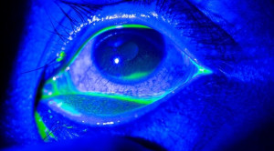 Tetracaine Topikal Jangka Pendek Efektif untuk Tata Laksana Nyeri pada Abrasi Kornea – Telaah Jurnal Alomedika