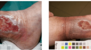 Peran Nutrisi pada Penyembuhan Luka Ulkus Diabetik