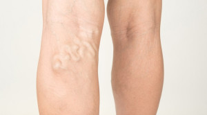 Terapi Profilaksis Deep Vein Thrombosis pada Pasien Keganasan