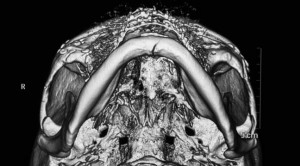 Manifestasi Klinis dan Pilihan Terapi pada Fraktur Basis Cranii