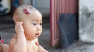 Strategi Non-Intervensi Aktif Pada Hemangioma Infantil