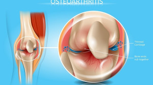 Diacerein untuk Penatalaksanaan Osteoarthritis